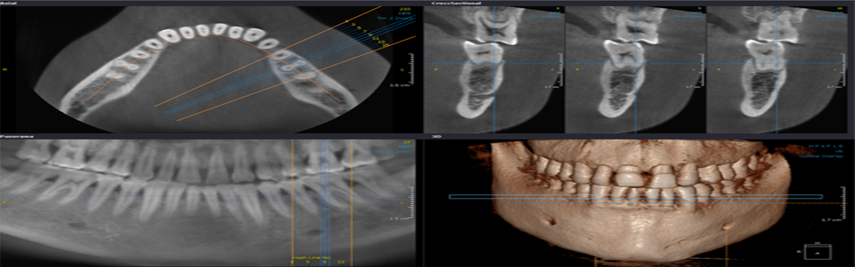 CONE BEAM
